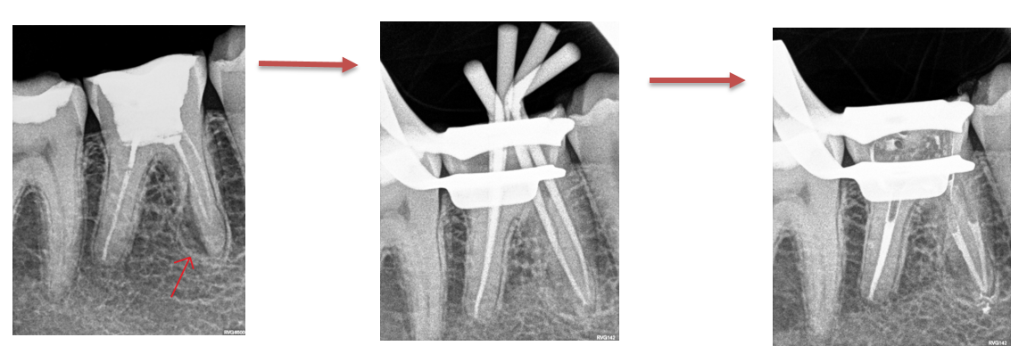 Danties fistulės gydymas endodontiniu pergydymu